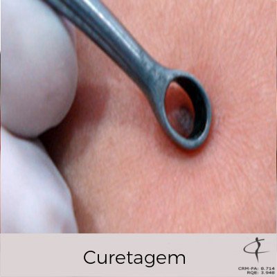 Curetagem